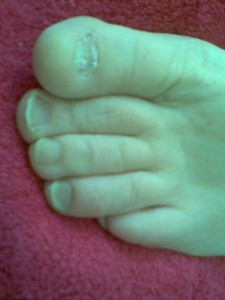 toe before